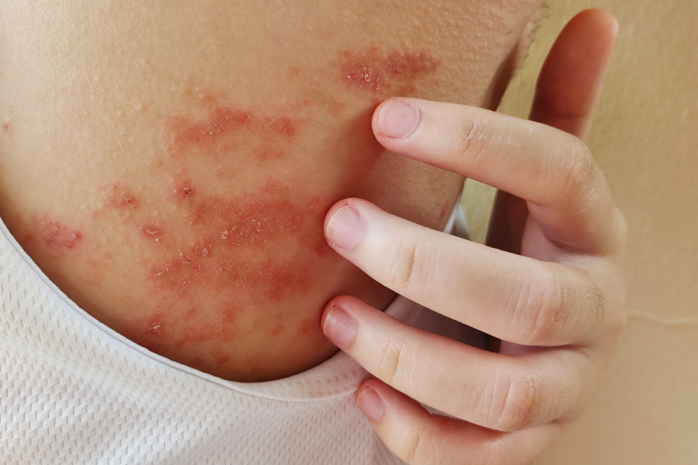 3 effective ways to manage atopic dermatitis